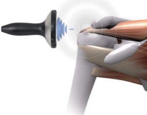 Shockwave therapy for pain treatment in Marin